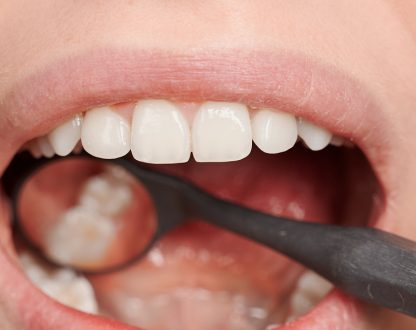 Choosing the Right Type of Dental Filling