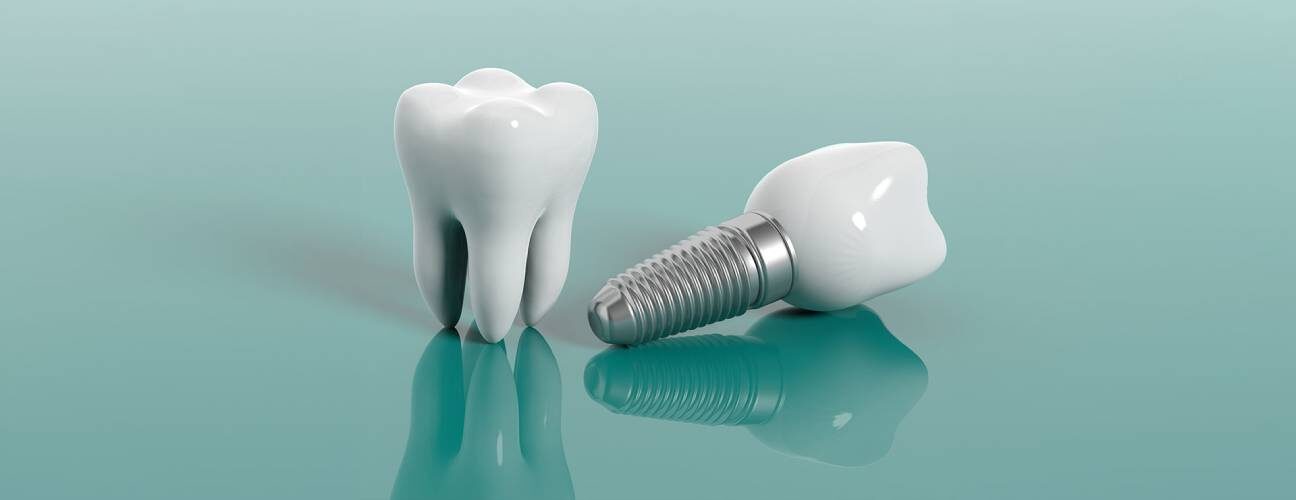 Dental Implants