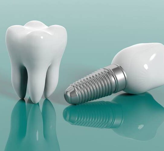 Dental Implants