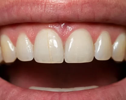 Vertical Hairline Crack in Front Tooth: Best Treatment Options